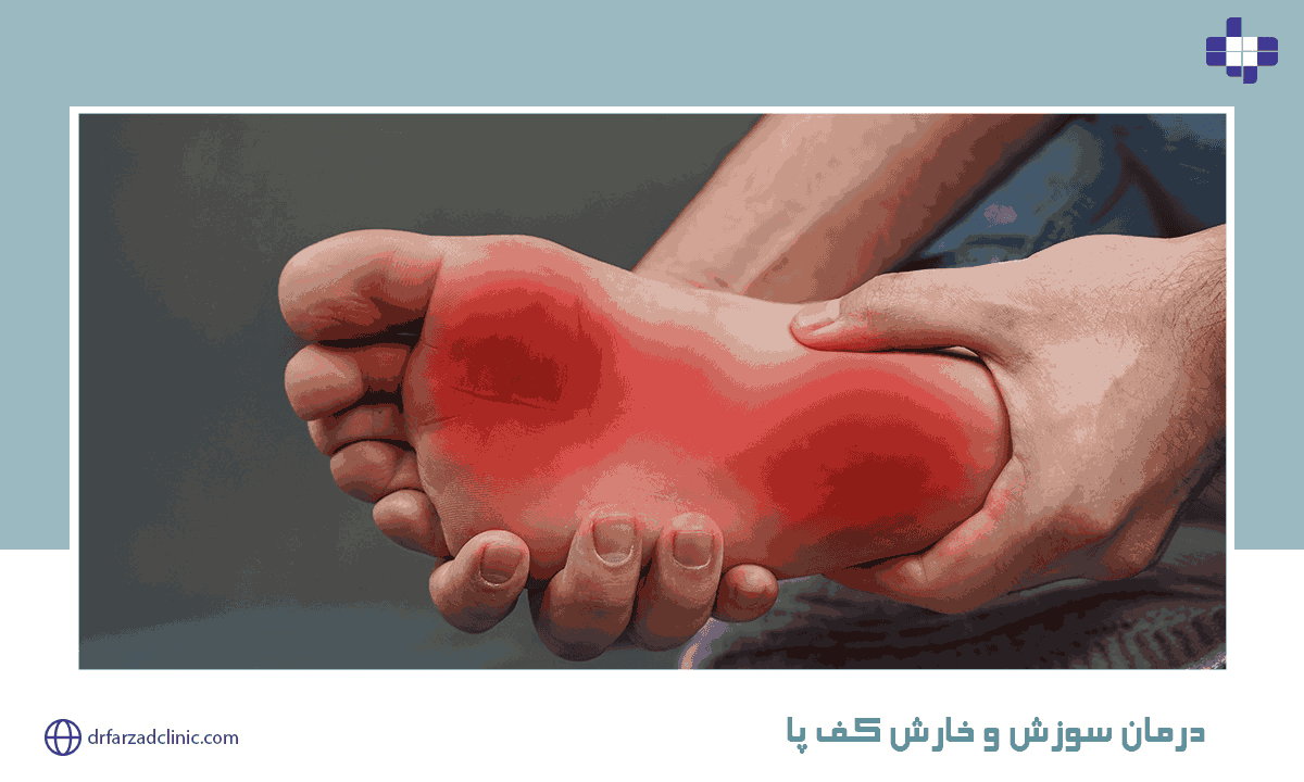 درمان سوزش و خارش کف پا